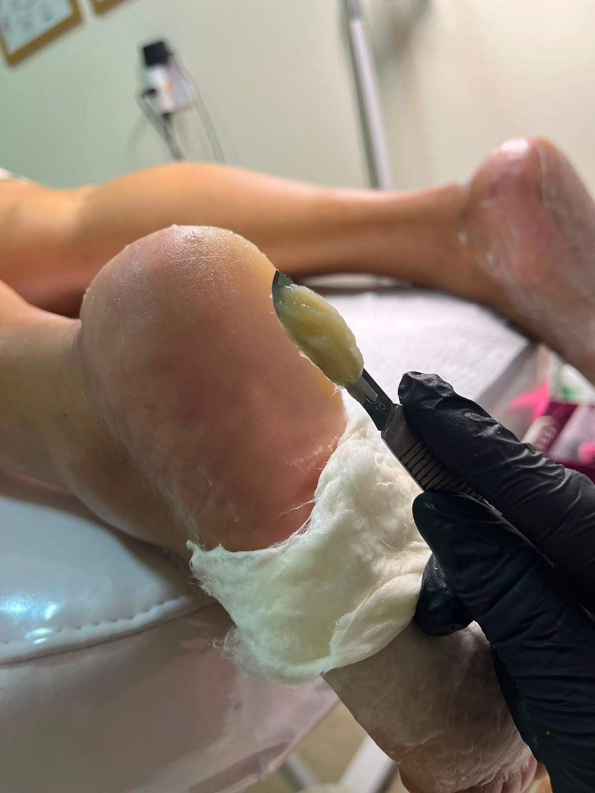 Desbaste Plantar